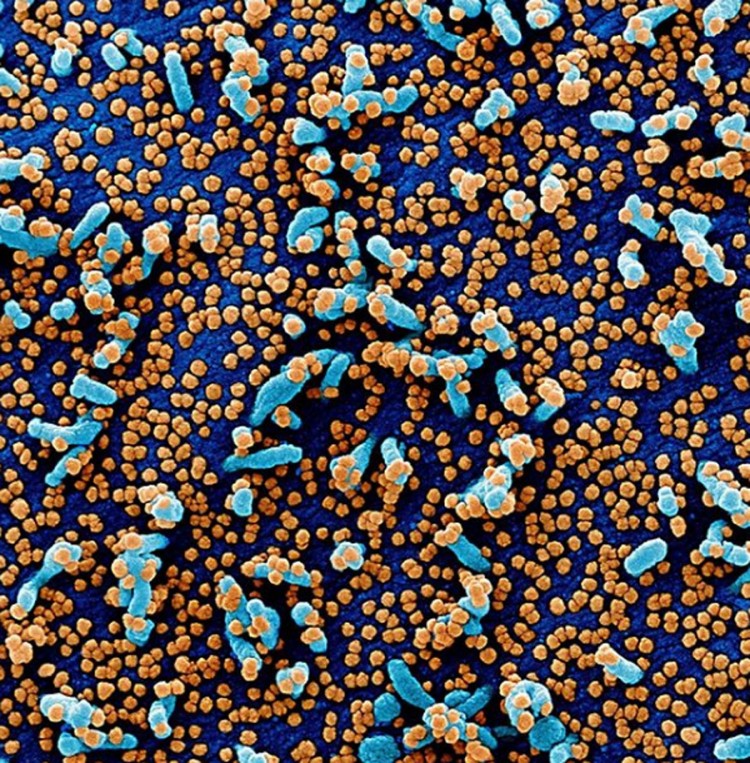 Obojeni mikroskopski prikaz ćelije VERO E6 (plavo) inficirane česticama virusa korona (narandžasto)